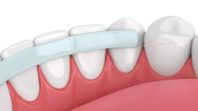 Can Teeth Bonding Be Used on Both Front and Back Teeth?