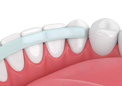 Can Teeth Bonding Be Used on Both Front and Back Teeth?